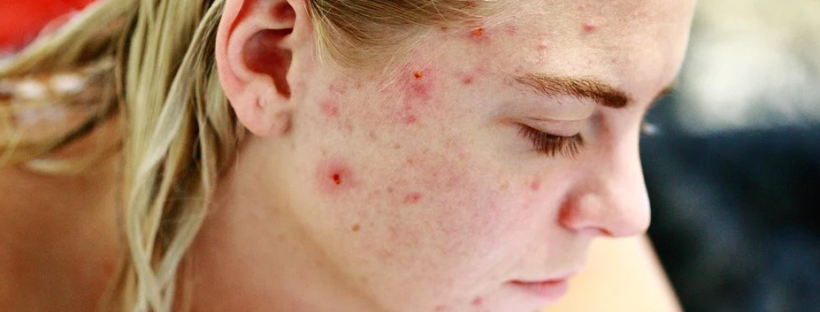 acne featured