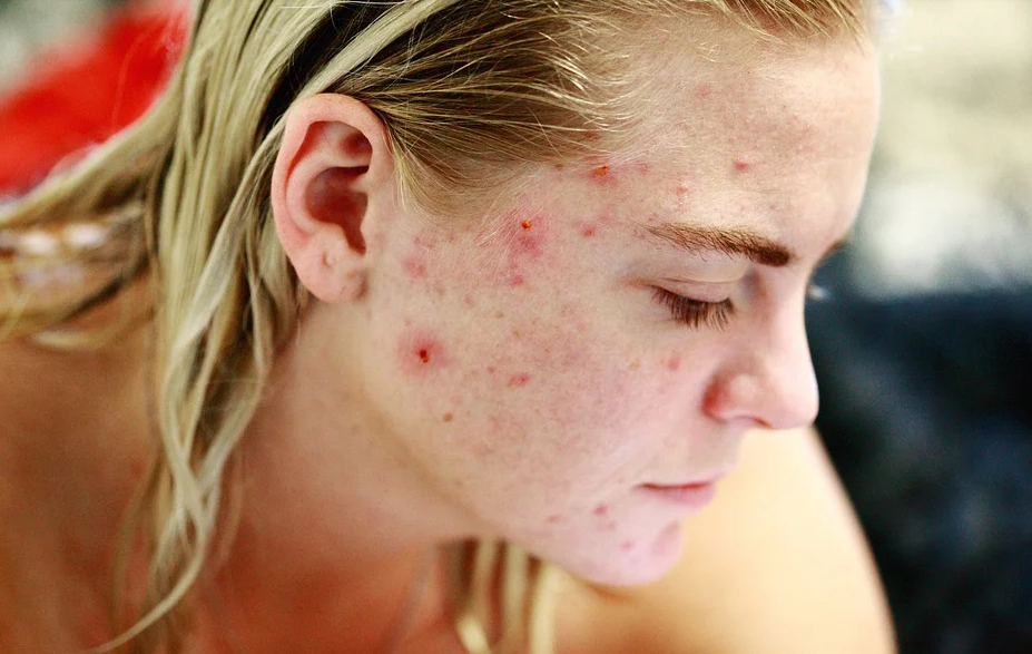acne featured